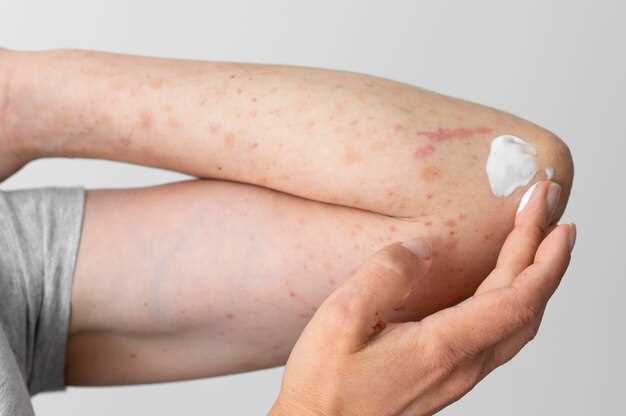 Understanding dermatitis